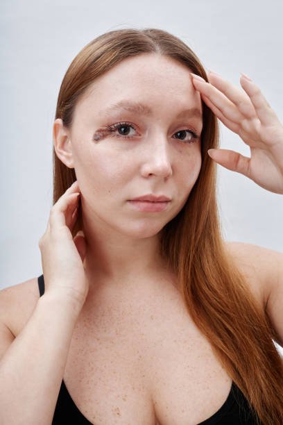 How Skin Type Influences Treatment for Removing Birthmarks